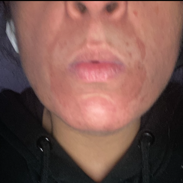 Before and after: SHIFAH customer with red burns around the mouth after a Hydrafacial, then calm, healed skin