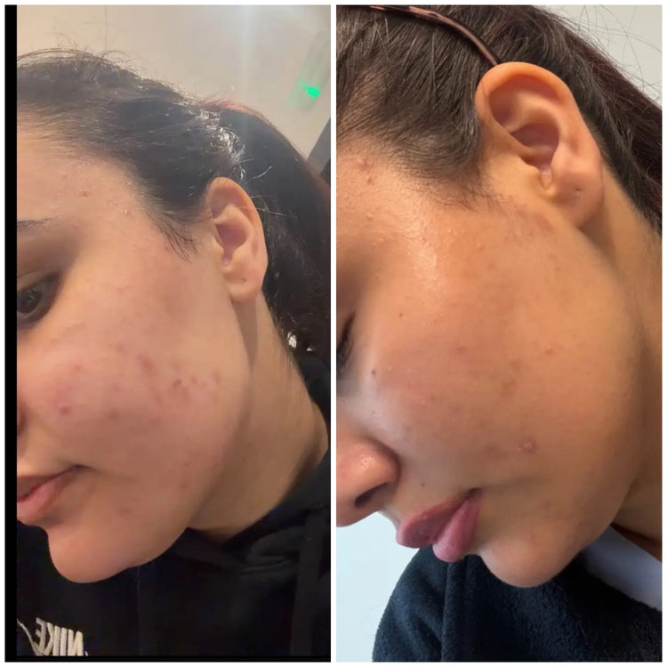 SHIFAH customer side-by-side cheek comparison showing changes in the appearance of blemishes and dark marks